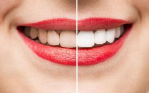Có nên tẩy trắng răng và đây là câu trả lời bất ngờ